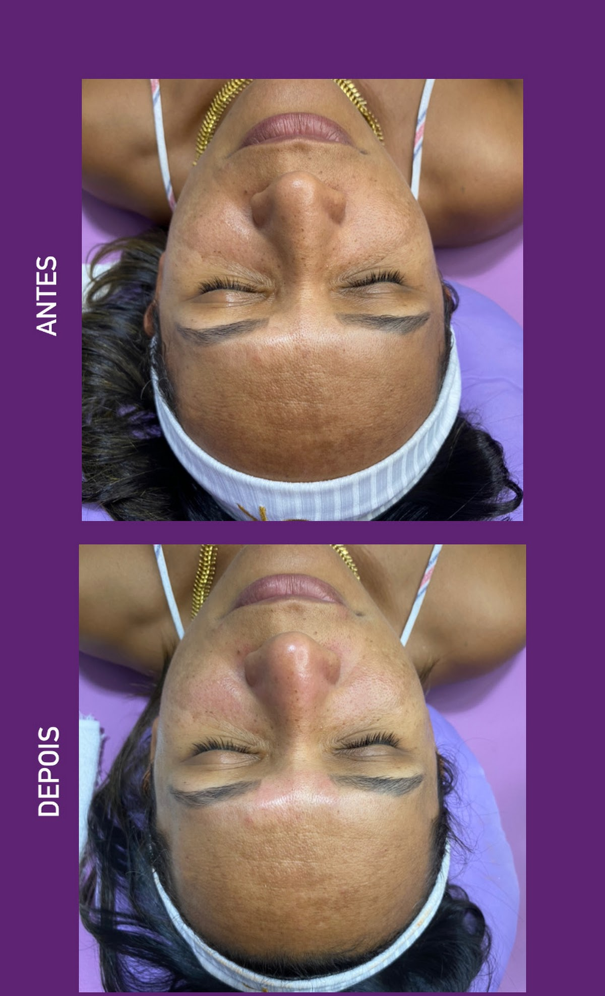 Revitalização Facial